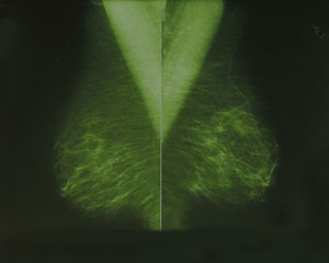 x-ray of a breast