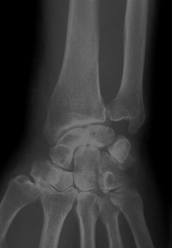 x-ray of wrist