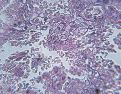 A histological slide shows the cellular effects of an HIV infection.