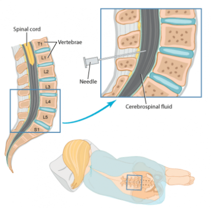 lumbar puncture pictures