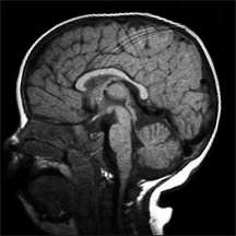 Normal human MRI. Credit: W.B.Dobyns