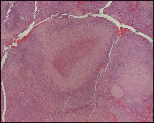 Bartonella in Tissue Biopsy