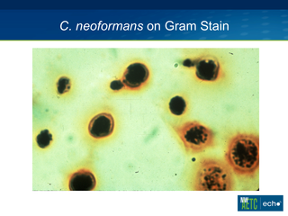 Meningitis in HIV by Christina M. Marra, MD Meningitis in HIV