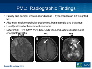 Progressive Multifocal Leukoencephalopathy (PML) by Robert D. Harrington, MD Progressive Multifocal Leukoencephalopathy (PML)