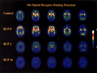 Opioid Use Disorders by Joseph Merrill, MD, MPH Opioid Use Disorders