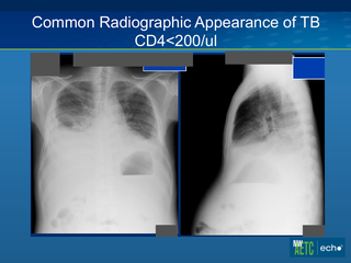 Tuberculosis Overview by Christopher Spitters, MD, MPH Tuberculosis Overview