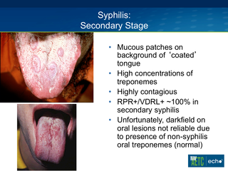 Presentation & Management of Syphilis in the Setting of HIV by Jeanne Marrazzo, MD, MPH Presentation & Management of Syphilis in the Setting of HIV