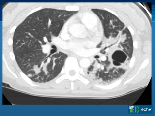 Pneumocystis Pneumonia (PCP): Part I by Brian R. Wood, MD Pneumocystis Pneumonia (PCP): Part I