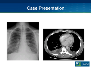 Immune Reconstitution Syndrome, 2013 by Robert D. Harrington, MD Immune Reconstitution Syndrome, 2013