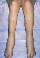 click for detail - edema of the legs