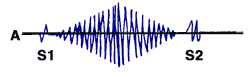 midsystolic