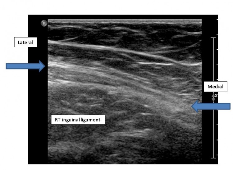 Inguinal Hernia On Ultrasound Images And Photos Finder