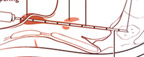 Sinus Tract Surgery