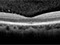 In vivo OCT imaging of Retina and Choroid 