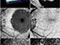 In vivo OCT imaging of Retina and Choroid 