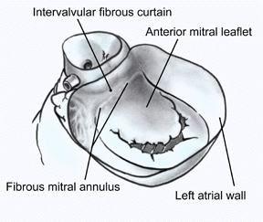 Mitral Annular Fibrosa