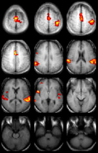 Bright colors show areas of brain activation in these functional magnetic resonance images.