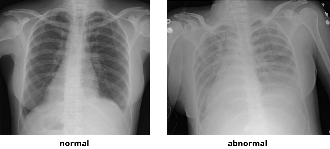 xray-normal-abnormal