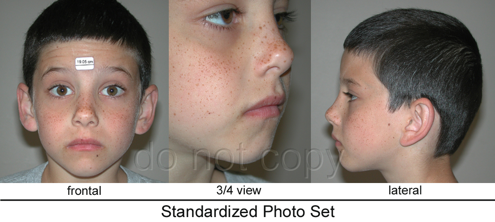 fetal alcohol syndrome facial features