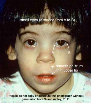 fetal alcohol syndrome eyes far apart