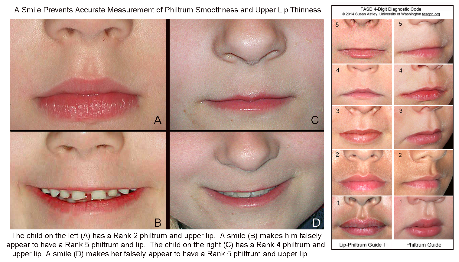 fetal alcohol syndrome facial features