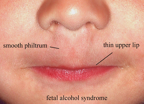 smooth philtrum