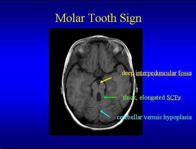 Molar Tooth Sign
