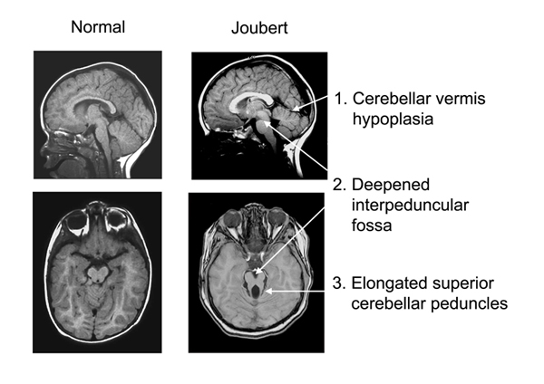 Joubert syndrome что это