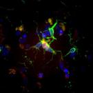 A view under a microscope of several microglia cells from the brain of a person who had Alzheimer’s disease during life.