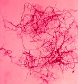 Acid fast stain of Nocardia asteroides