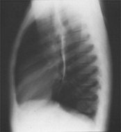 chest xray lateral view