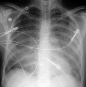 chest xray pulmonary edema