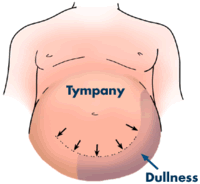 flank dullness