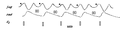 NSR Wave Pattern
