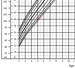 arm span measurements plotted on a height-for-age chart