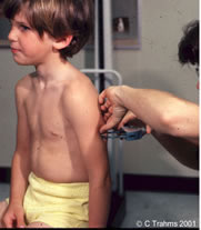 triceps skinfold measurement