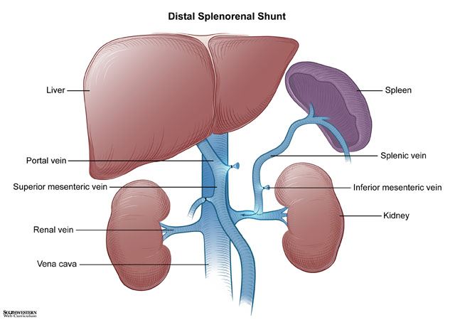 splenorenal shunt