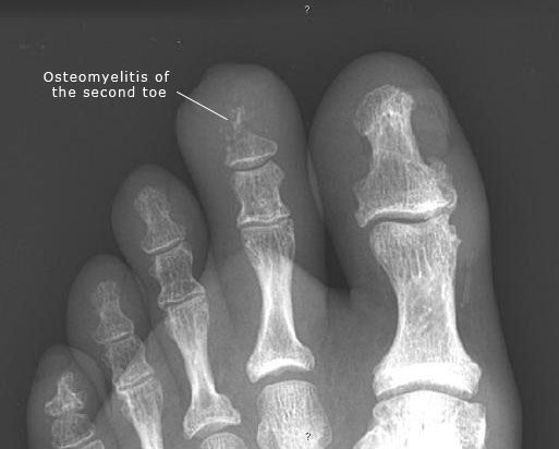 Osteomyelitis X Ray Diabetic Foot Image Radiopaedia Osteomyelitis X Ray Diabetic Foot Image Radiopaedia