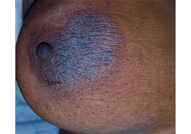 paget's disease of the breast