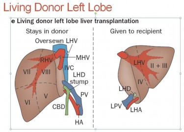 Diagram Liver Donor