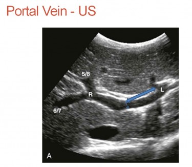 Liver Living Donor | UW Ultrasound