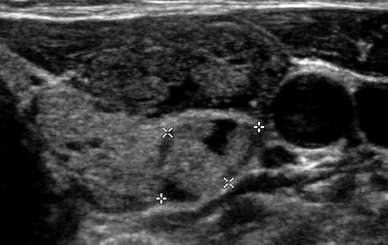 Thyroid / Head and Neck | UW Ultrasound