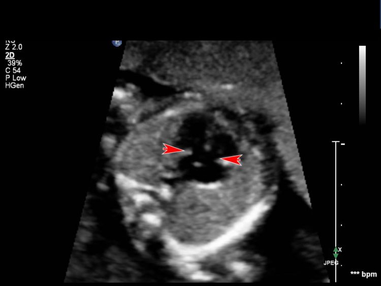 Case 5 UW MEDICINE ULTRASOUND