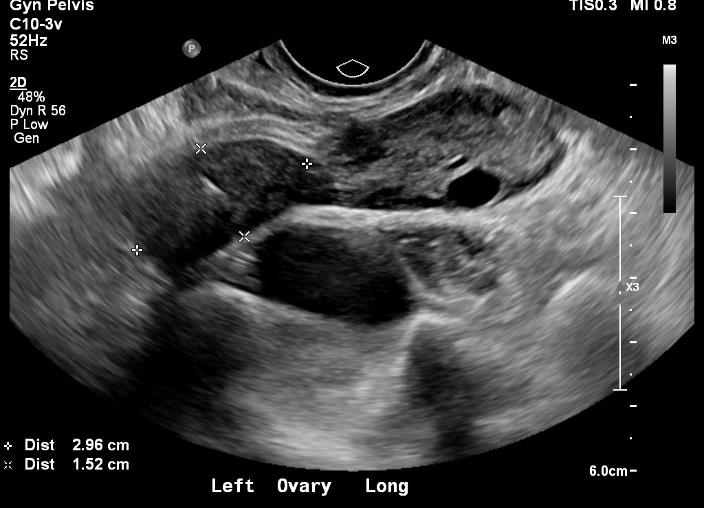 Case 3 | UW MEDICINE ULTRASOUND