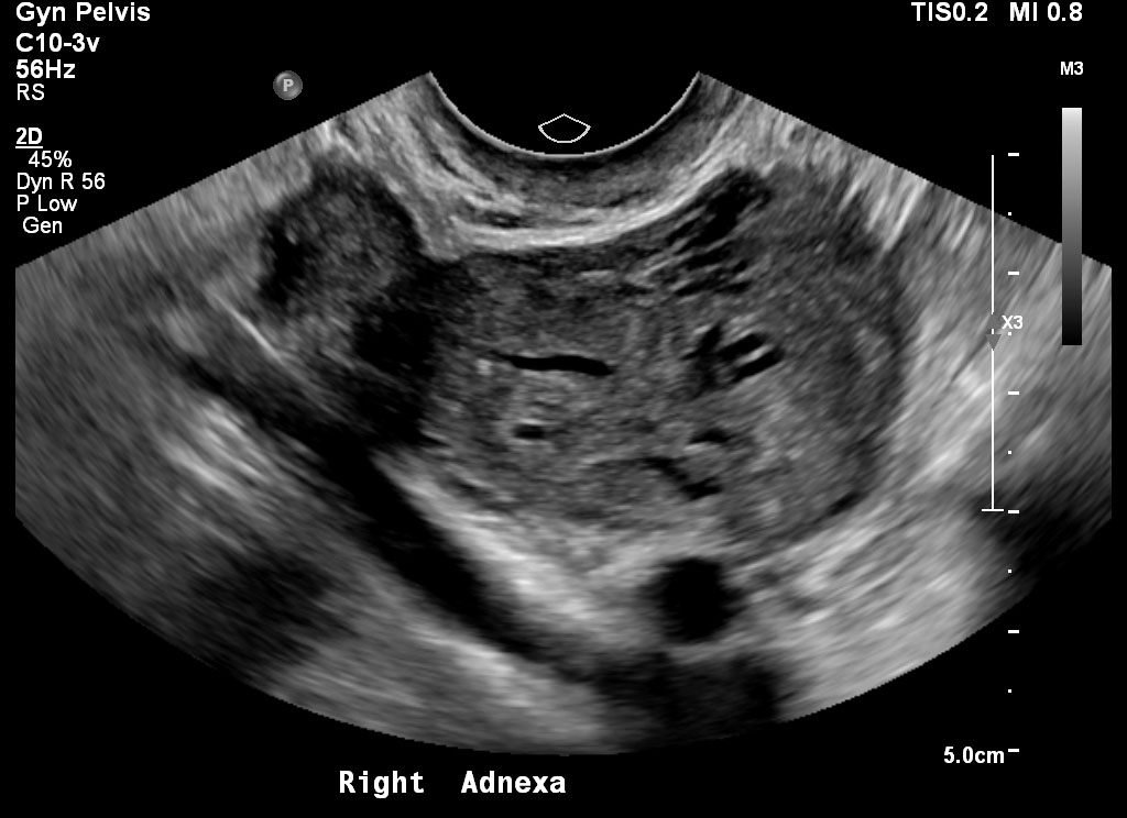 Case 3 | UW MEDICINE ULTRASOUND